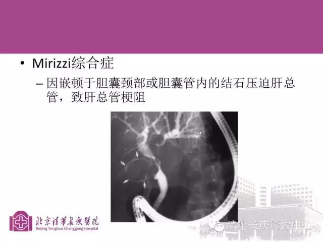 影像PPT - 【病例】胆管高分化腺癌1例CT及MR-39