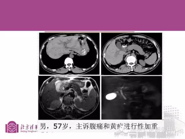 影像PPT - 【病例】胆管高分化腺癌1例CT及MR-41