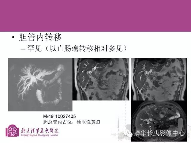 影像PPT - 【病例】胆管高分化腺癌1例CT及MR-42