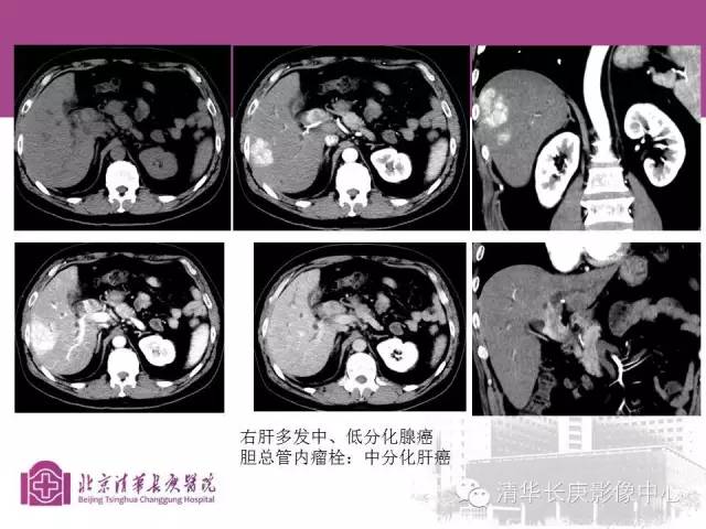 影像PPT - 【病例】胆管高分化腺癌1例CT及MR-43