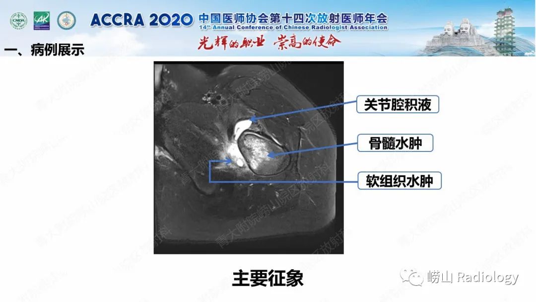 影像PPT - 【PPT】关节内骨样骨瘤的影像诊断-8