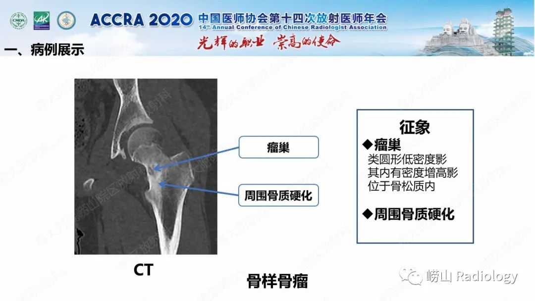 影像PPT - 【PPT】关节内骨样骨瘤的影像诊断-10