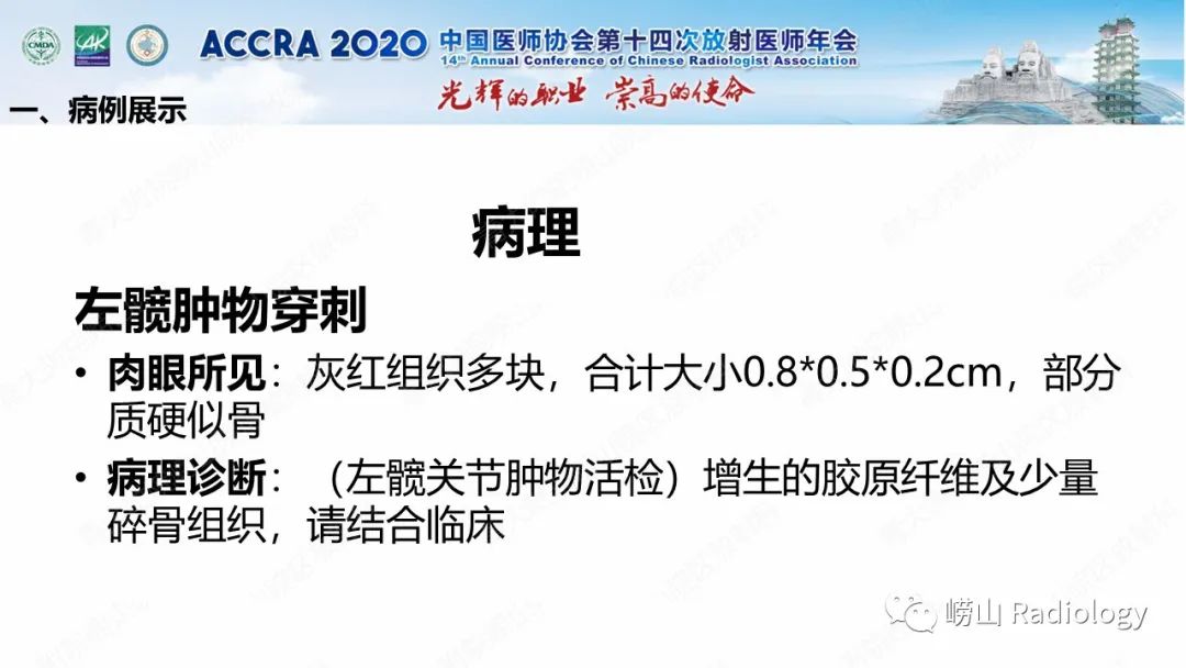 影像PPT - 【PPT】关节内骨样骨瘤的影像诊断-11