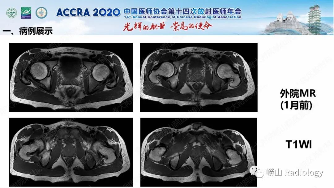 影像PPT - 【PPT】关节内骨样骨瘤的影像诊断-14