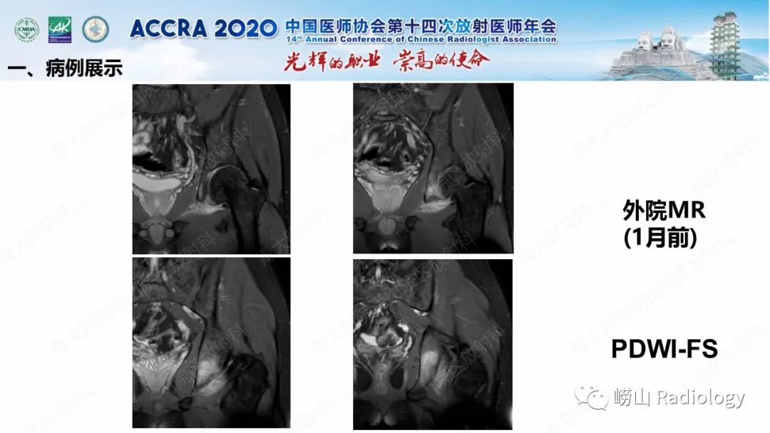 影像PPT - 【PPT】关节内骨样骨瘤的影像诊断-16