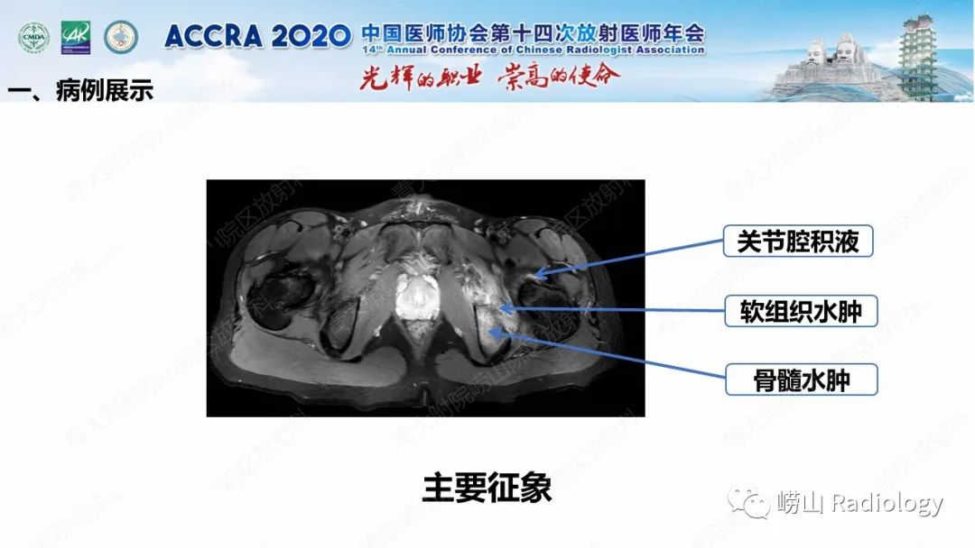 影像PPT - 【PPT】关节内骨样骨瘤的影像诊断-17