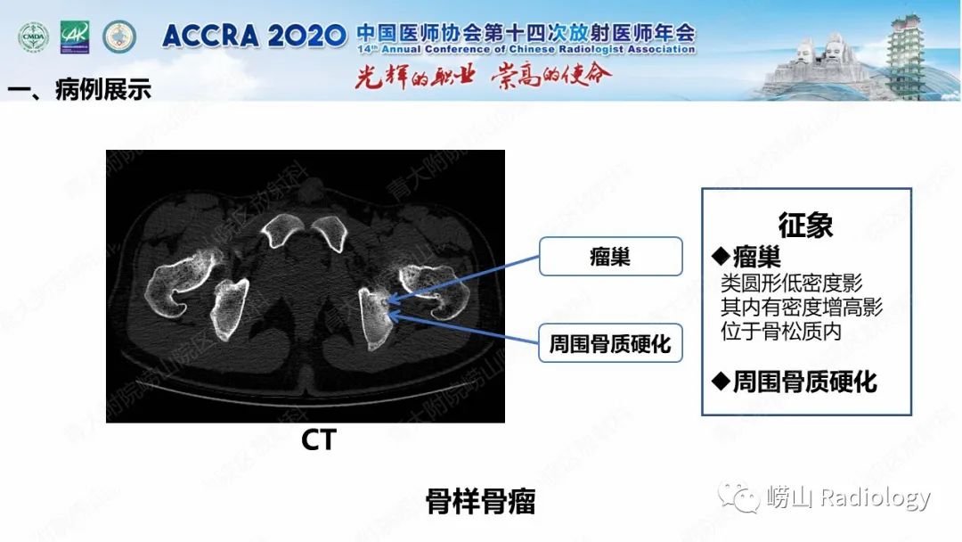 影像PPT - 【PPT】关节内骨样骨瘤的影像诊断-18