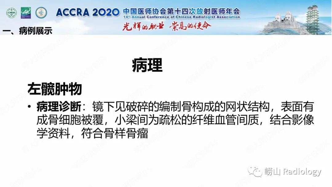 影像PPT - 【PPT】关节内骨样骨瘤的影像诊断-19