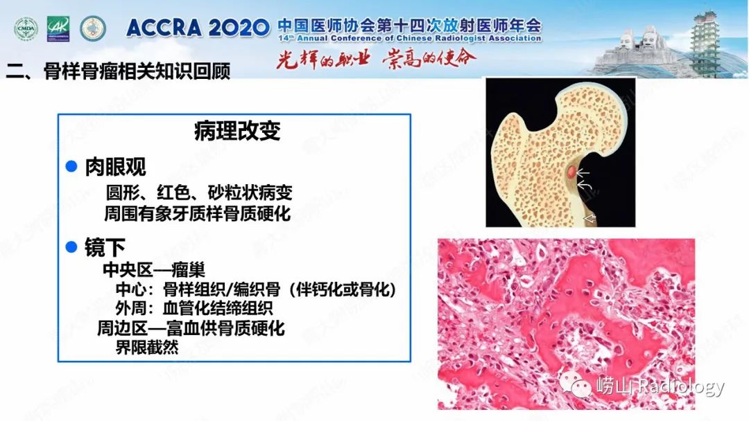影像PPT - 【PPT】关节内骨样骨瘤的影像诊断-21