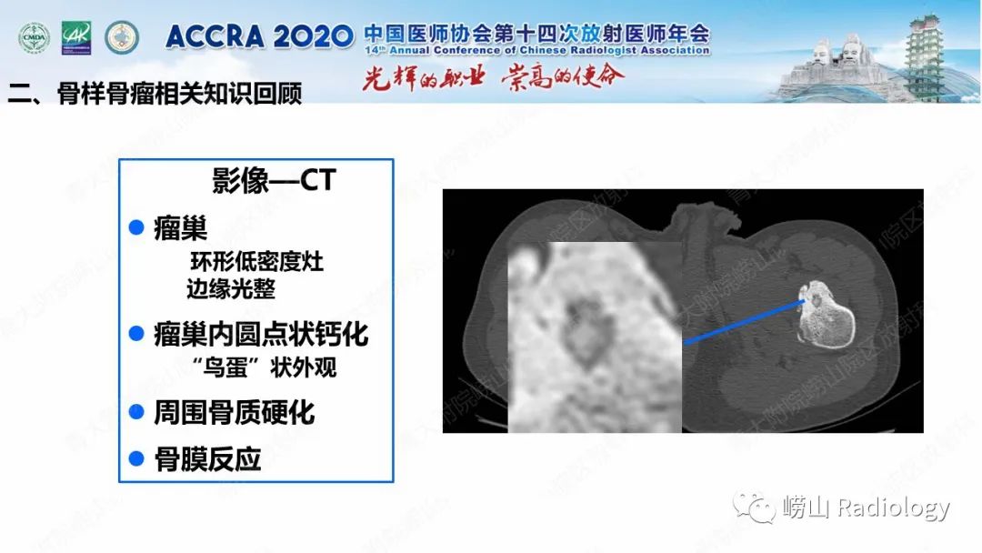 影像PPT - 【PPT】关节内骨样骨瘤的影像诊断-23