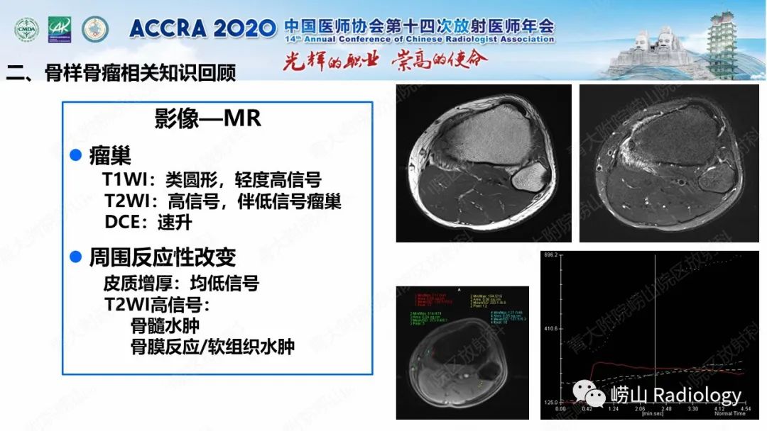 影像PPT - 【PPT】关节内骨样骨瘤的影像诊断-24