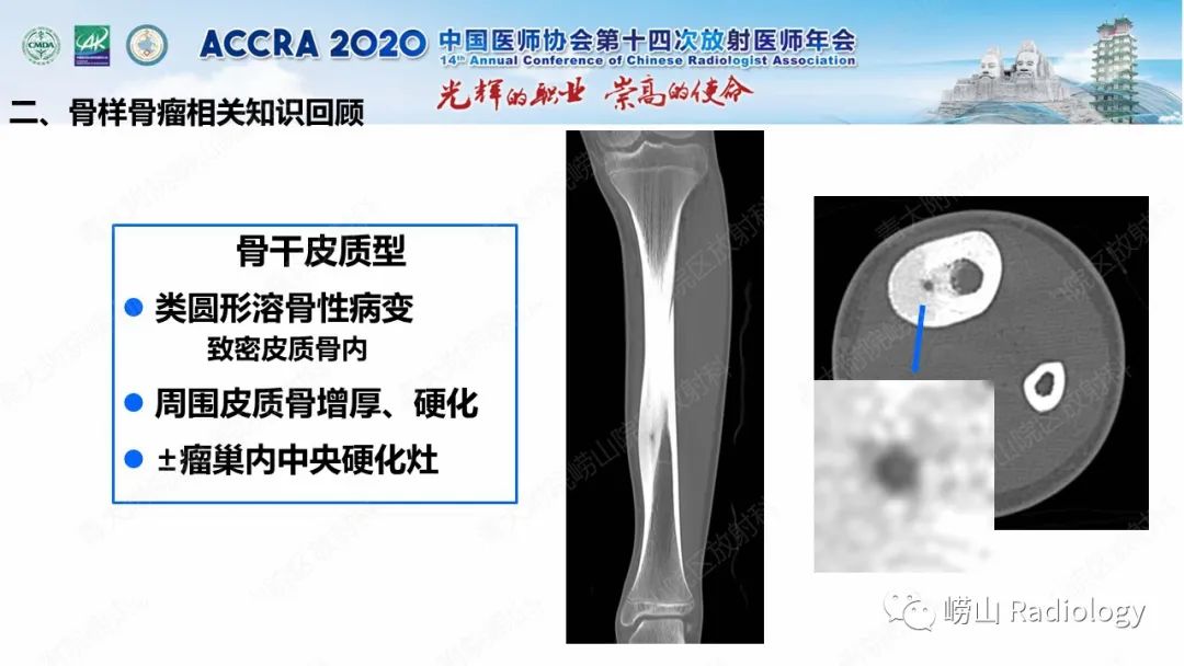 影像PPT - 【PPT】关节内骨样骨瘤的影像诊断-25
