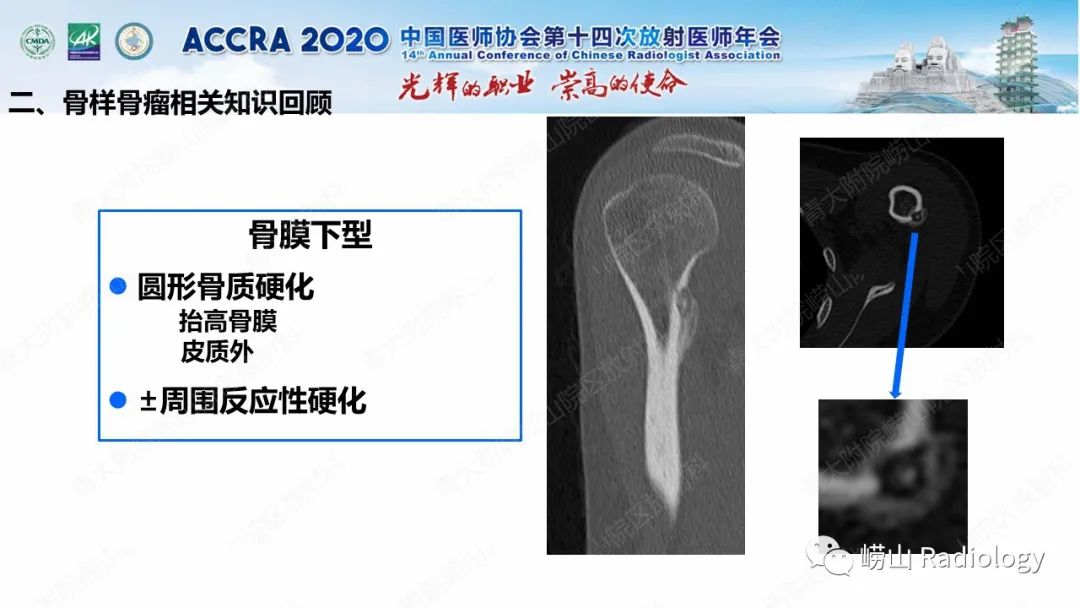 影像PPT - 【PPT】关节内骨样骨瘤的影像诊断-26
