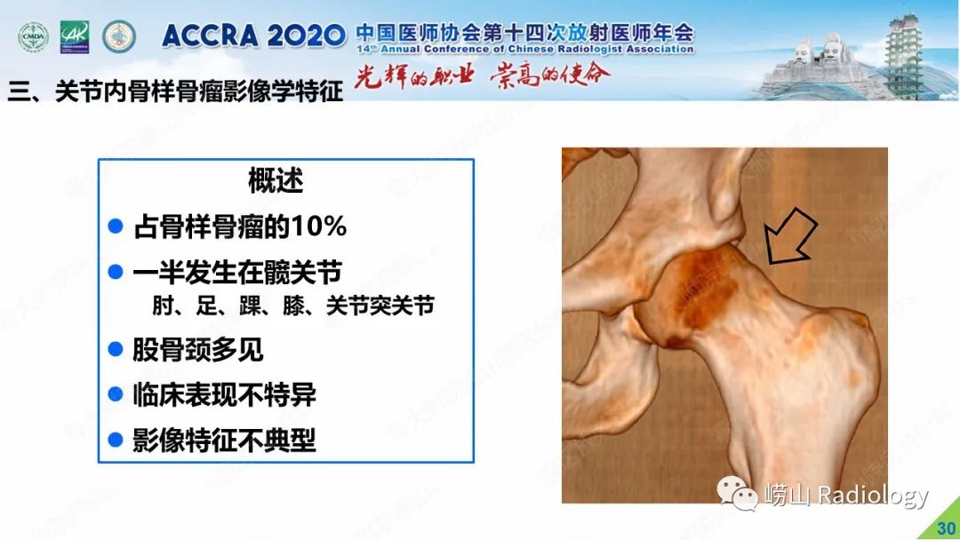 影像PPT - 【PPT】关节内骨样骨瘤的影像诊断-29