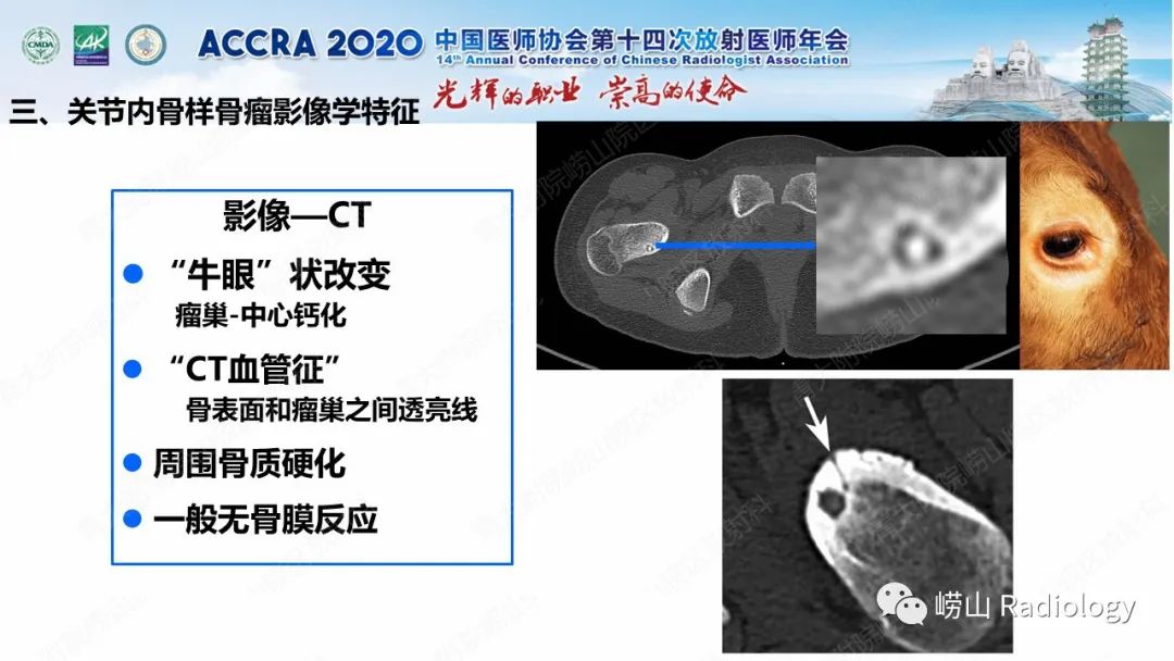 影像PPT - 【PPT】关节内骨样骨瘤的影像诊断-31