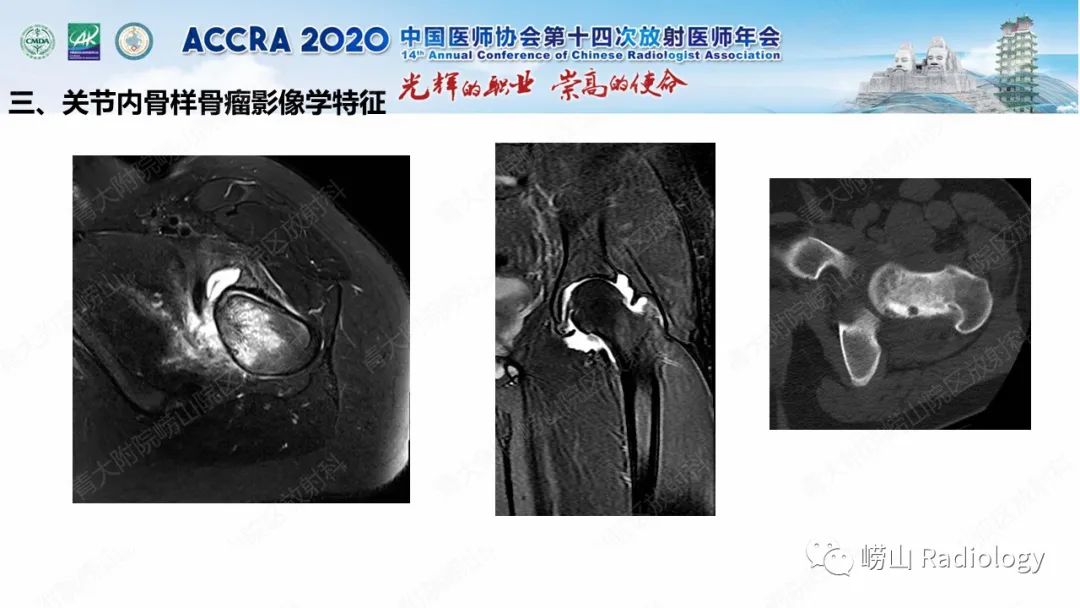 影像PPT - 【PPT】关节内骨样骨瘤的影像诊断-33