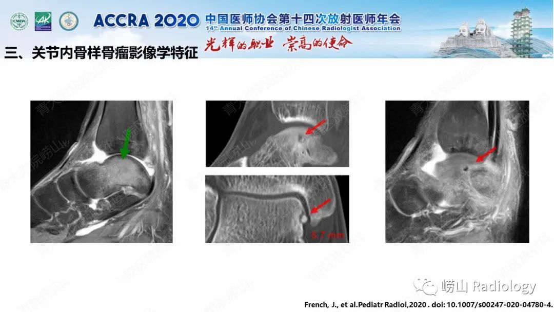 影像PPT - 【PPT】关节内骨样骨瘤的影像诊断-37