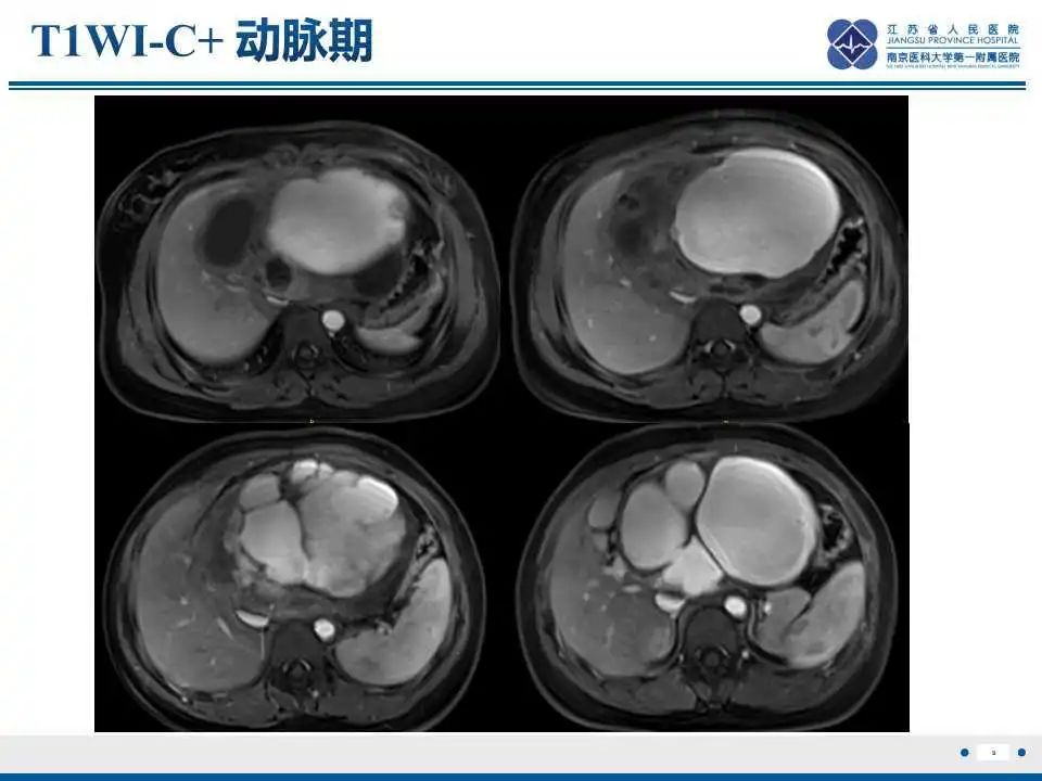 影像PPT - 【PPT】肝间叶性错构瘤-10