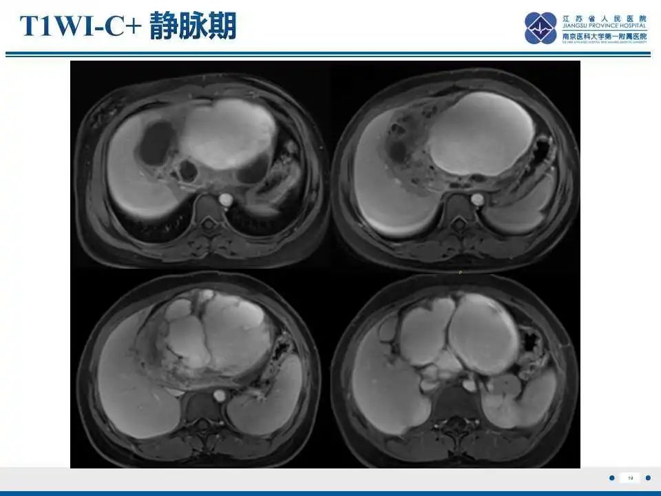 影像PPT - 【PPT】肝间叶性错构瘤-11