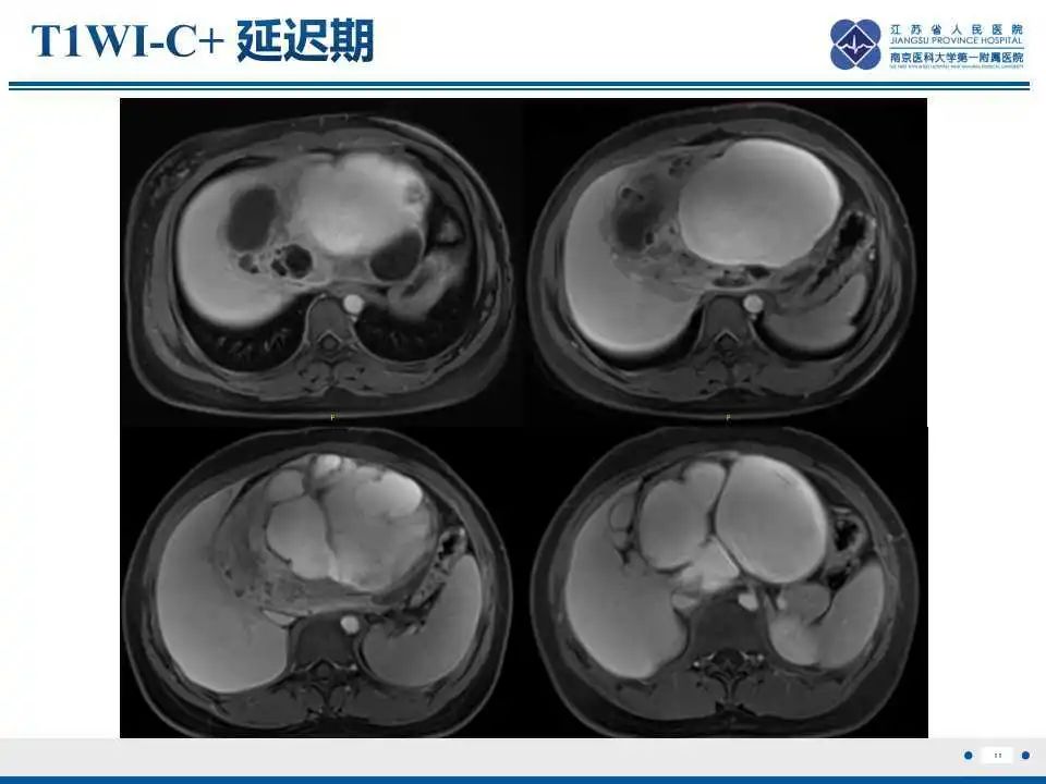 影像PPT - 【PPT】肝间叶性错构瘤-12