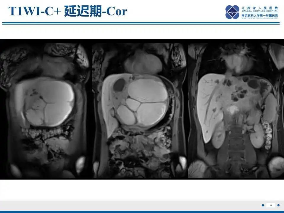 影像PPT - 【PPT】肝间叶性错构瘤-13