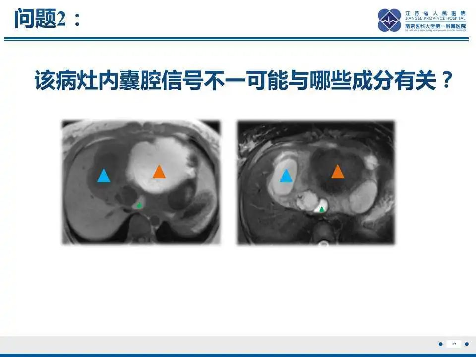 影像PPT - 【PPT】肝间叶性错构瘤-16
