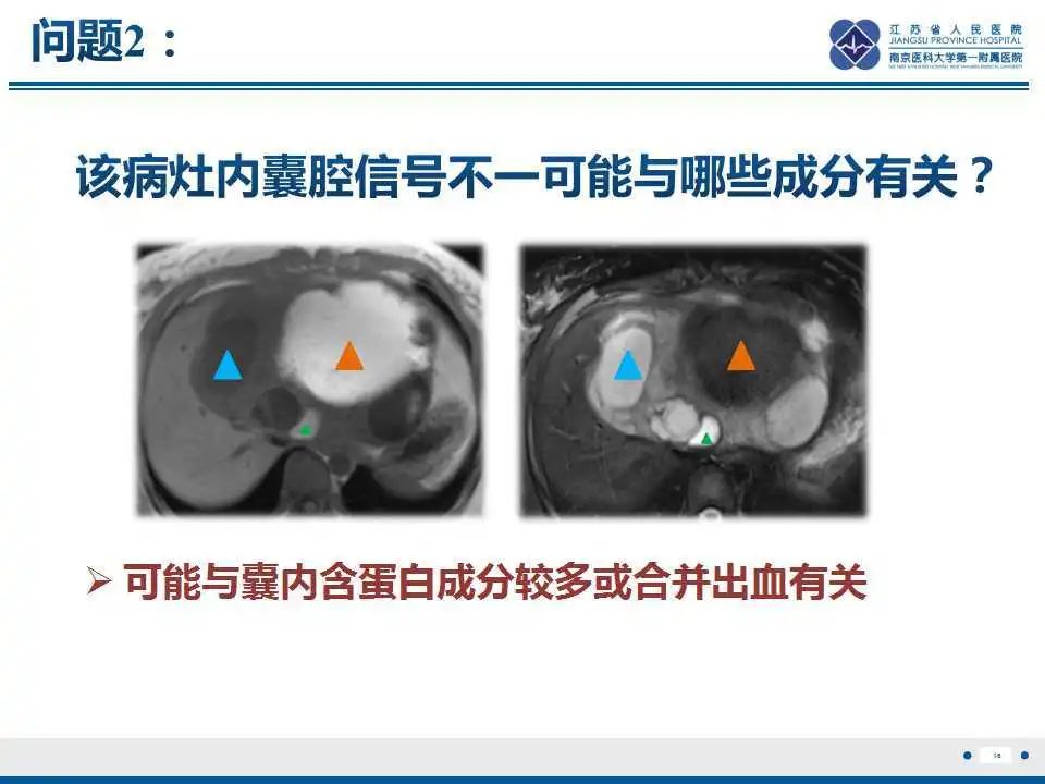 影像PPT - 【PPT】肝间叶性错构瘤-17