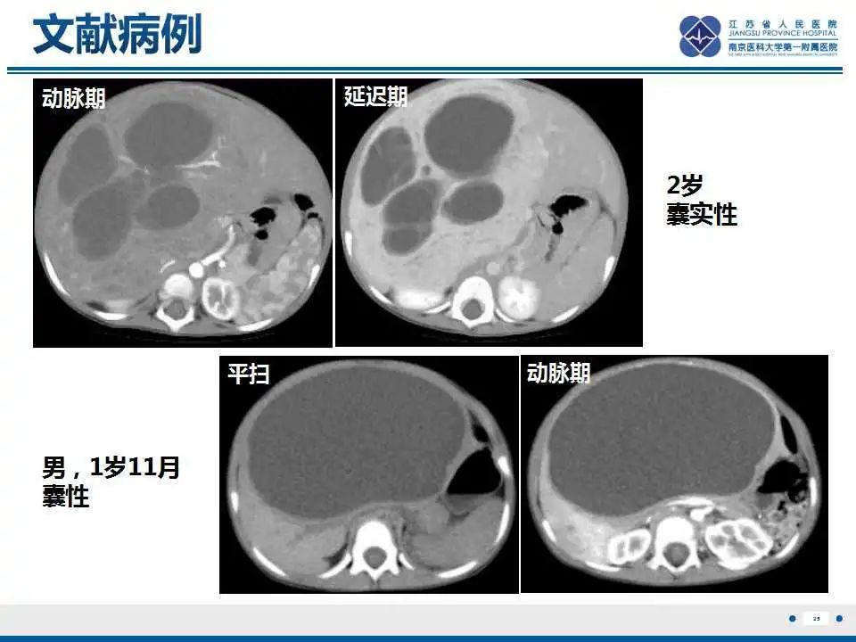 影像PPT - 【PPT】肝间叶性错构瘤-26