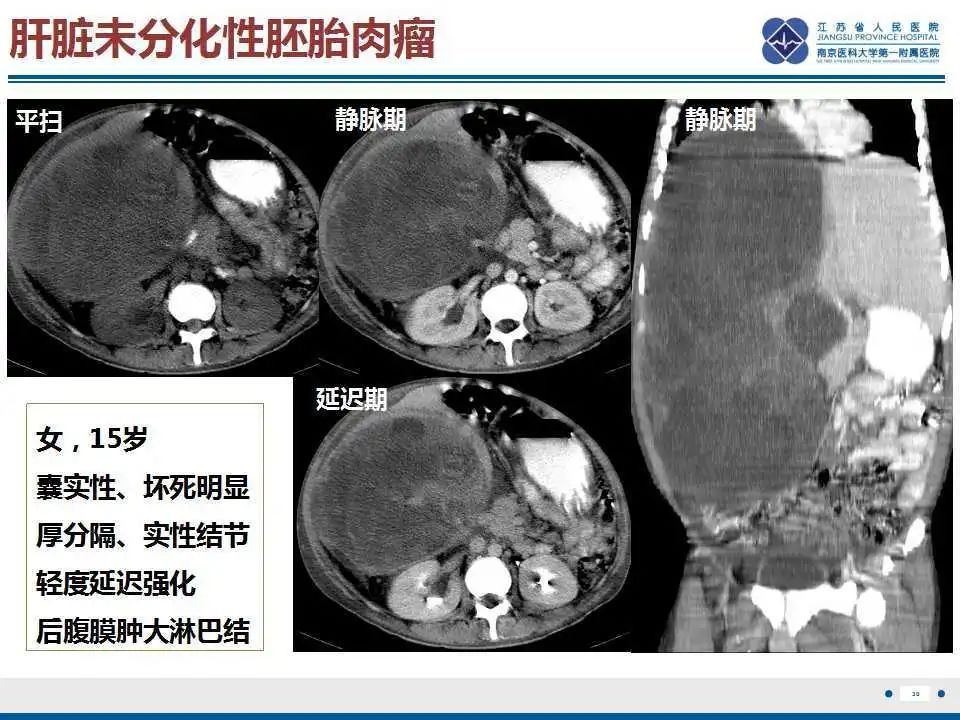影像PPT - 【PPT】肝间叶性错构瘤-31