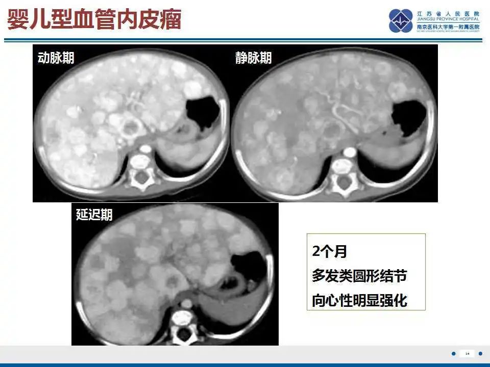 影像PPT - 【PPT】肝间叶性错构瘤-35