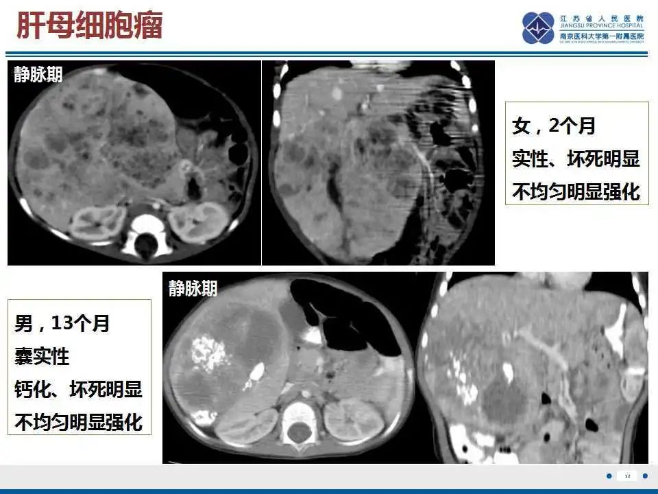影像PPT - 【PPT】肝间叶性错构瘤-33