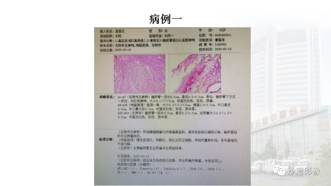 影像PPT - 【PPT】卵巢T2WI低信号病变分析-9 影像PPT - 【PPT】卵巢T2WI低信号病变分析-9