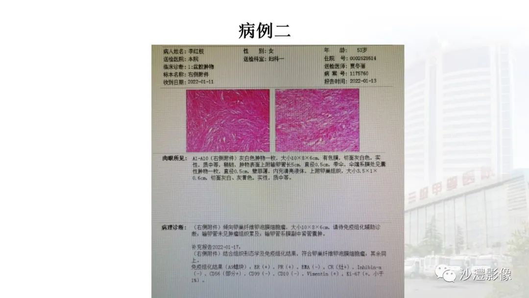 影像PPT - 【PPT】卵巢T2WI低信号病变分析-10 影像PPT - 【PPT】卵巢T2WI低信号病变分析-10