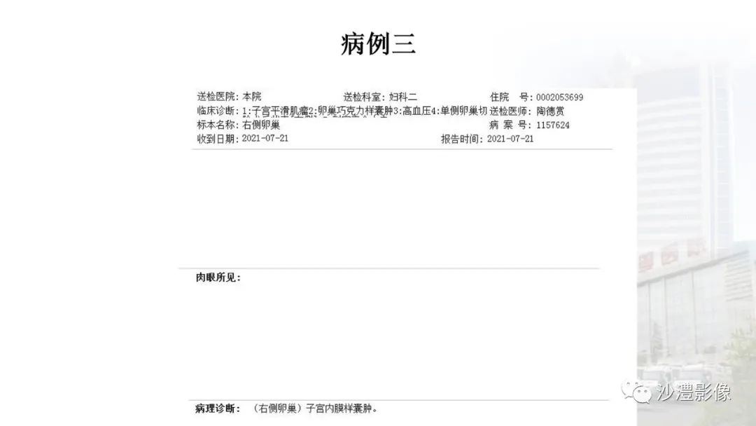 影像PPT - 【PPT】卵巢T2WI低信号病变分析-11 影像PPT - 【PPT】卵巢T2WI低信号病变分析-11