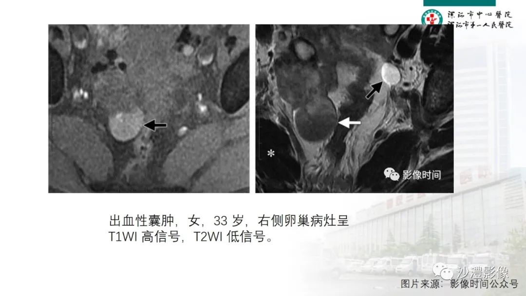 影像PPT - 【PPT】卵巢T2WI低信号病变分析-24 影像PPT - 【PPT】卵巢T2WI低信号病变分析-24