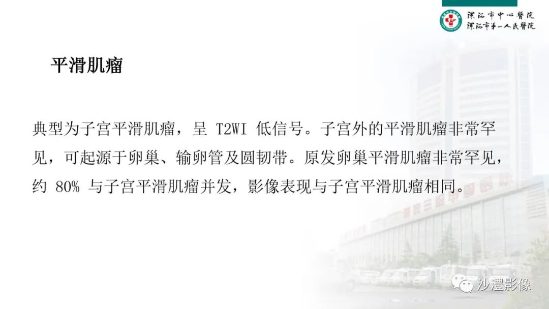 影像PPT - 【PPT】卵巢T2WI低信号病变分析-28 影像PPT - 【PPT】卵巢T2WI低信号病变分析-28