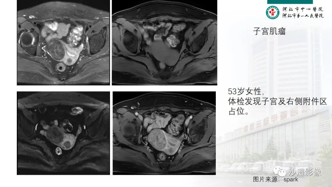 影像PPT - 【PPT】卵巢T2WI低信号病变分析-29 影像PPT - 【PPT】卵巢T2WI低信号病变分析-29