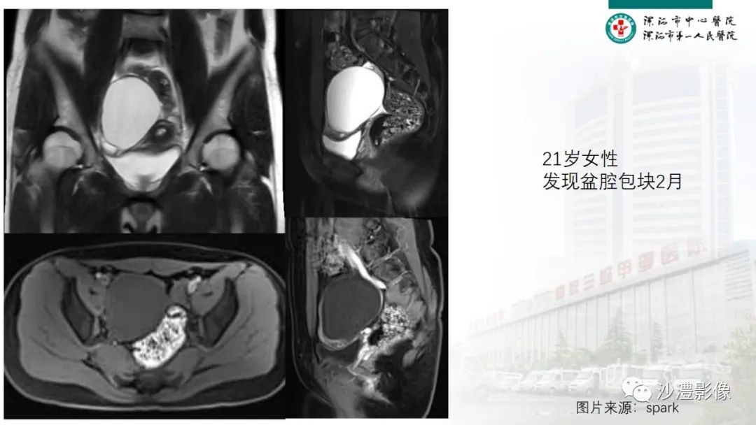 影像PPT - 【PPT】卵巢T2WI低信号病变分析-37 影像PPT - 【PPT】卵巢T2WI低信号病变分析-37
