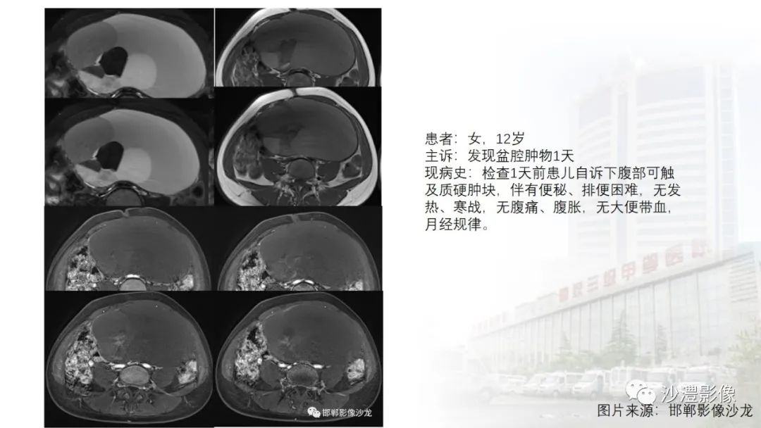 影像PPT - 【PPT】卵巢T2WI低信号病变分析-43 影像PPT - 【PPT】卵巢T2WI低信号病变分析-43