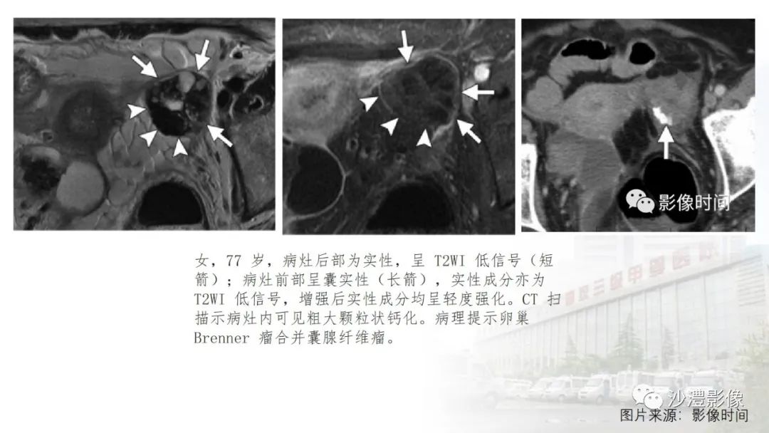 影像PPT - 【PPT】卵巢T2WI低信号病变分析-45 影像PPT - 【PPT】卵巢T2WI低信号病变分析-45