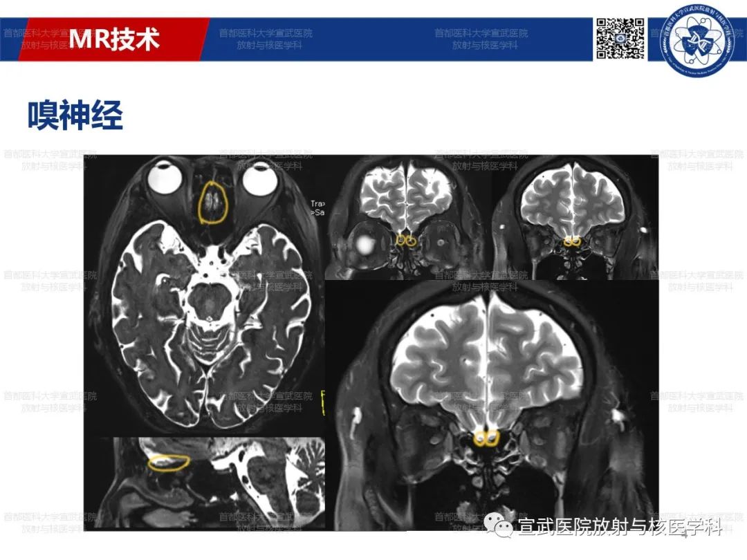 影像PPT - 【PPT】12对颅神经磁共振影像解剖-4