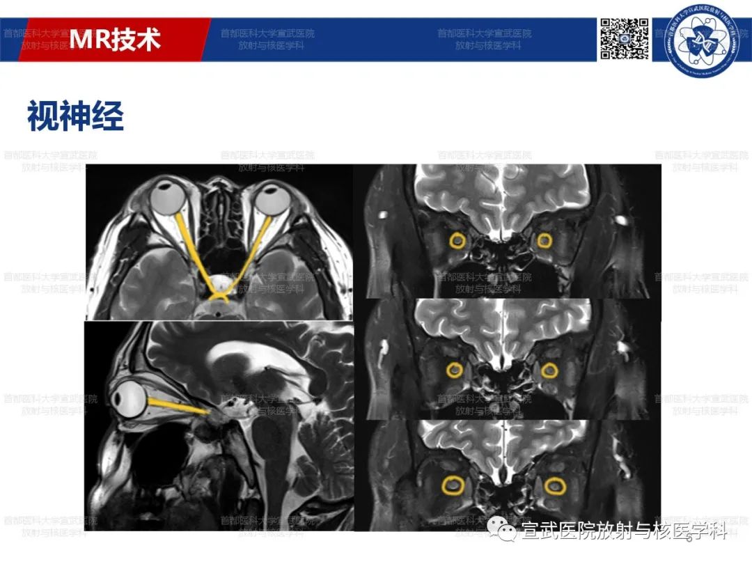 影像PPT - 【PPT】12对颅神经磁共振影像解剖-6