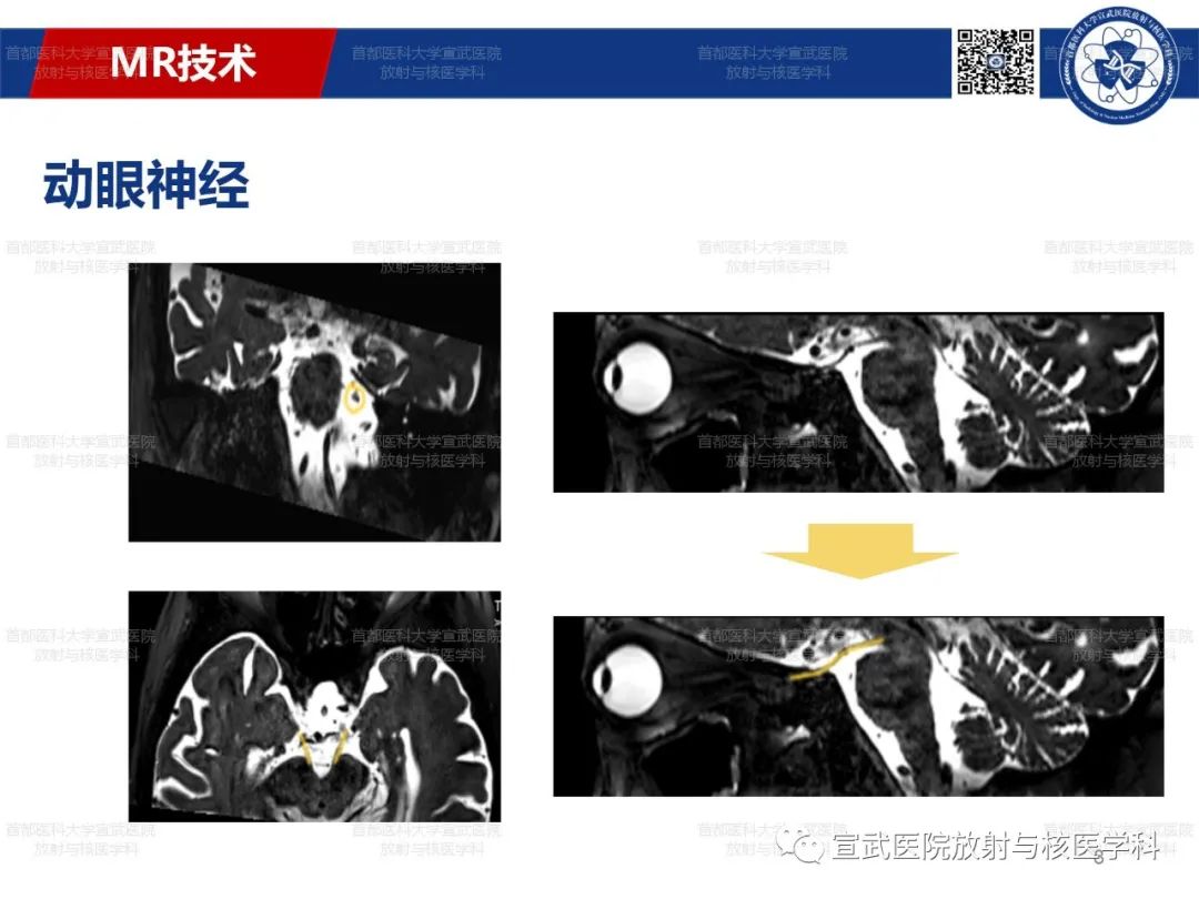 影像PPT - 【PPT】12对颅神经磁共振影像解剖-8