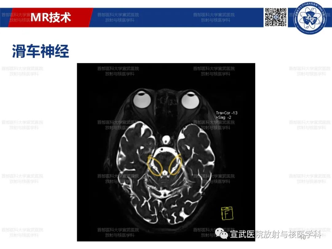 影像PPT - 【PPT】12对颅神经磁共振影像解剖-10