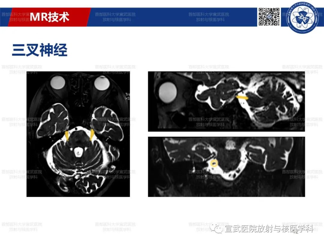 影像PPT - 【PPT】12对颅神经磁共振影像解剖-12