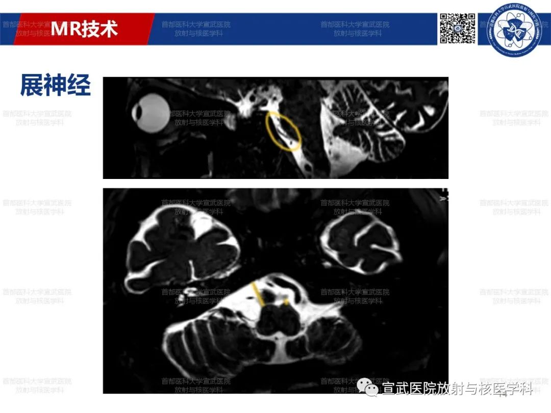 影像PPT - 【PPT】12对颅神经磁共振影像解剖-14