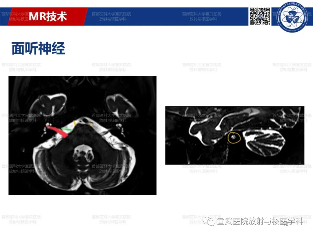 影像PPT - 【PPT】12对颅神经磁共振影像解剖-16