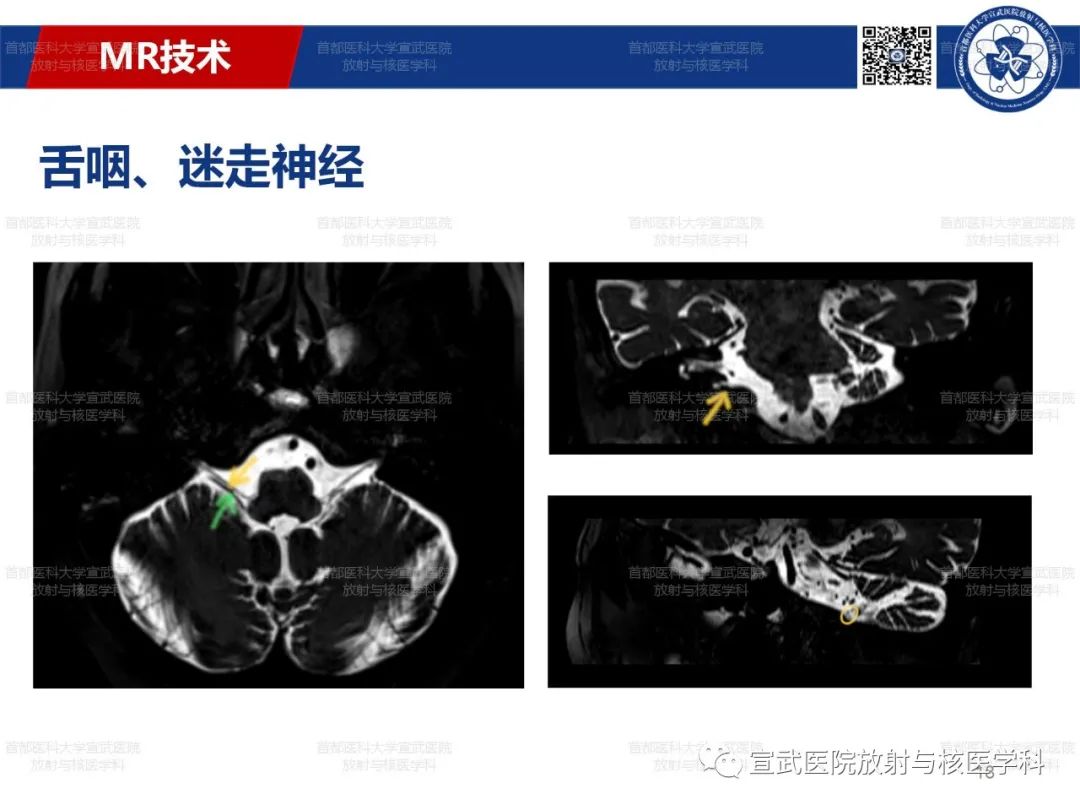 影像PPT - 【PPT】12对颅神经磁共振影像解剖-18