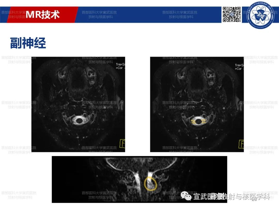 影像PPT - 【PPT】12对颅神经磁共振影像解剖-20