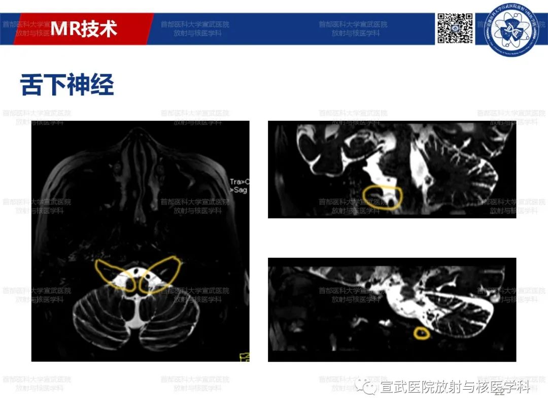 影像PPT - 【PPT】12对颅神经磁共振影像解剖-22